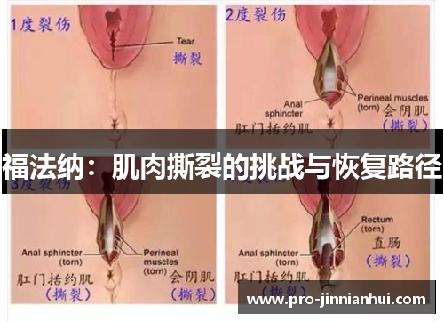 福法纳：肌肉撕裂的挑战与恢复路径